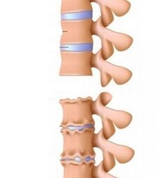 Estágios de rampas de osteocondrose do pescoço
