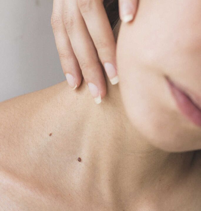 A rigidez no pescoço é um dos sintomas do estágio inicial da osteocondrose da coluna cervical