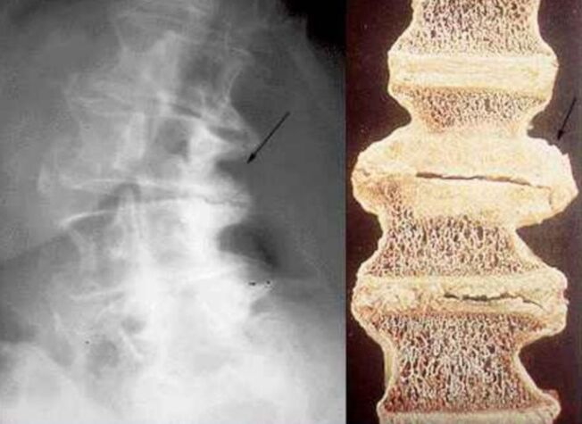 danos às vértebras na osteocondrose torácica