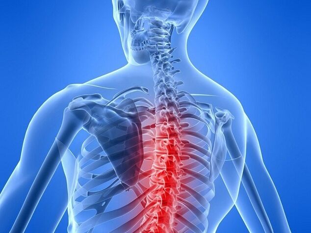 osteocondrose da coluna torácica