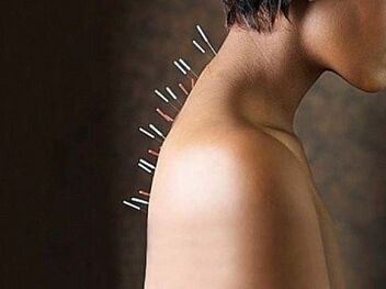 A reflexoterapia é um método eficaz de tratamento da osteocondrose cervical