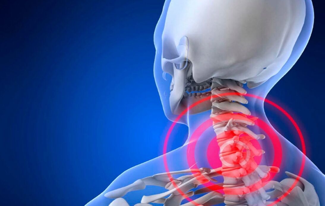 osteocondrose da coluna cervical
